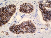 E-Cadherin_positiv